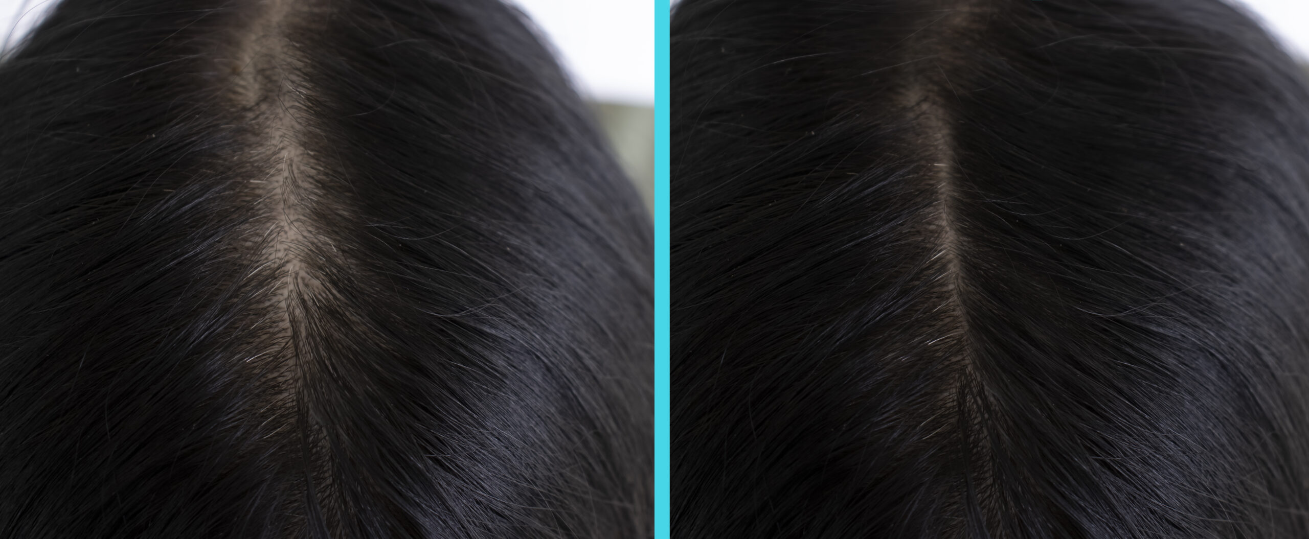 The Confidence Upgrade: How Expert Hair Replacement Systems Restore More Than Hair