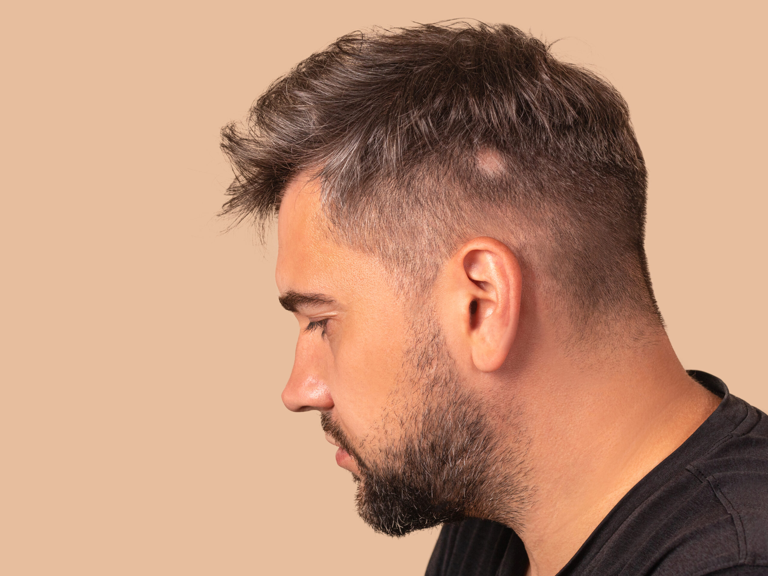 Choosing the Perfect Hair Replacement System: Achieve Natural, Confident Results