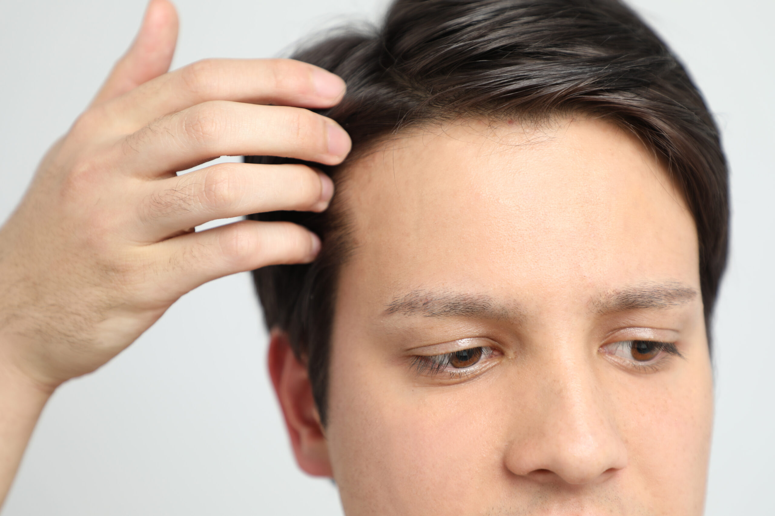 Unlock Your Confidence: The Benefits of Non-Surgical Hair Replacement for Men