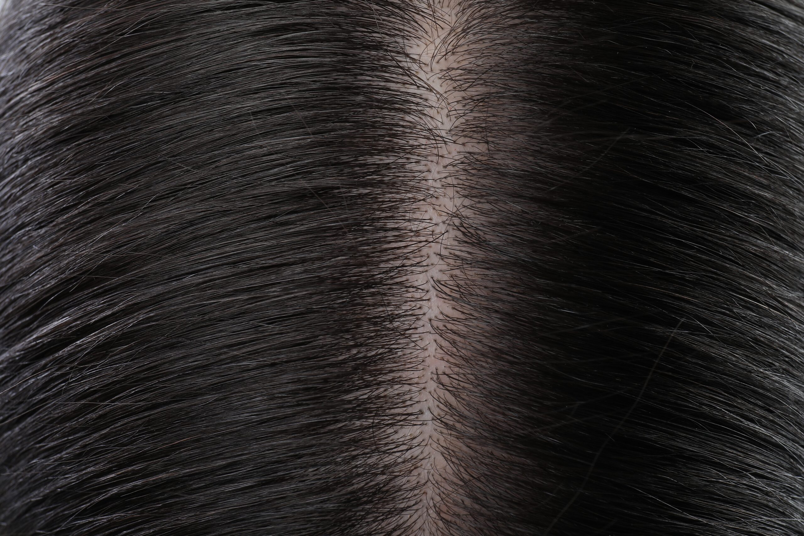 The Quiet Confidence: How Non-Surgical Hair Replacement Can Transform Your Look