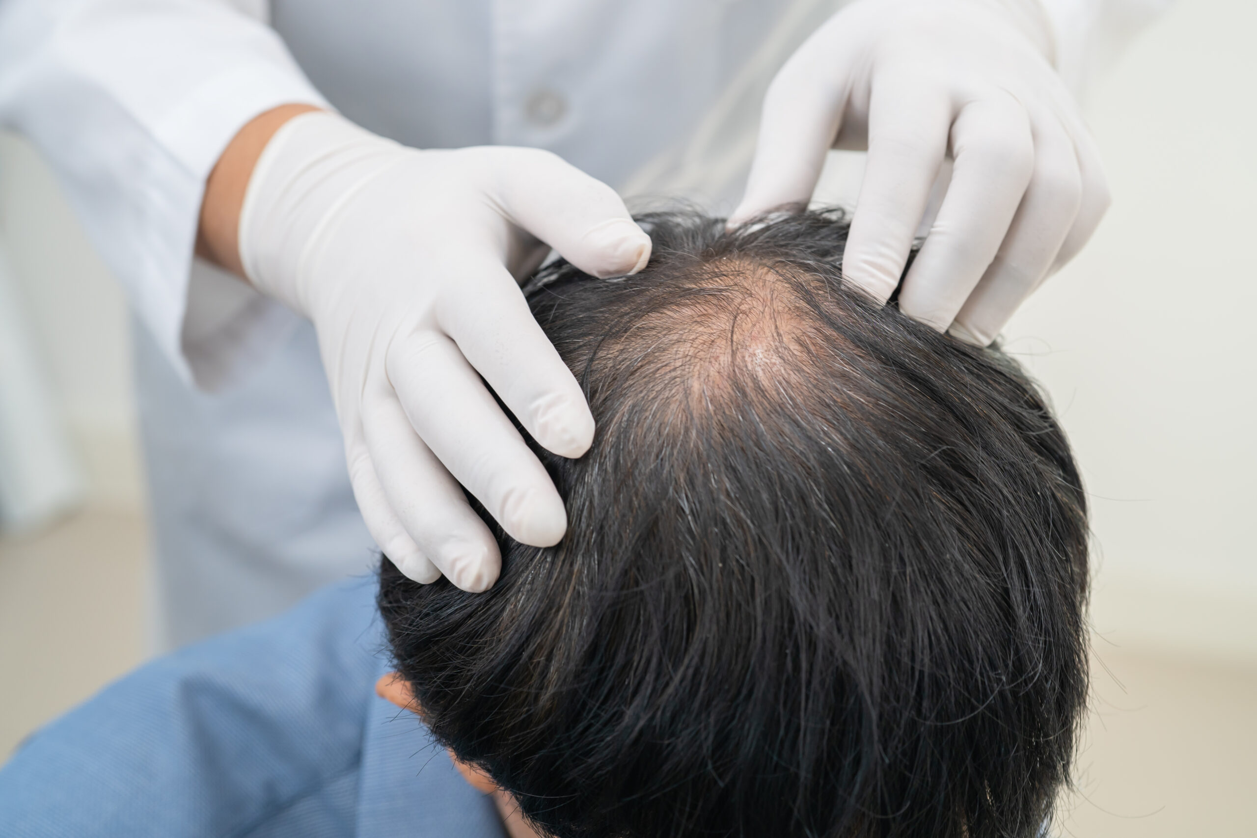 Thinking About a Hair System? What to Know Before You Book Your Consultation at BarberNBar Cheltenham